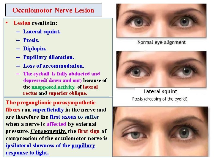 Occulomotor Nerve Lesion • Lesion results in: – Lateral squint. – Ptosis. – Diplopia.
