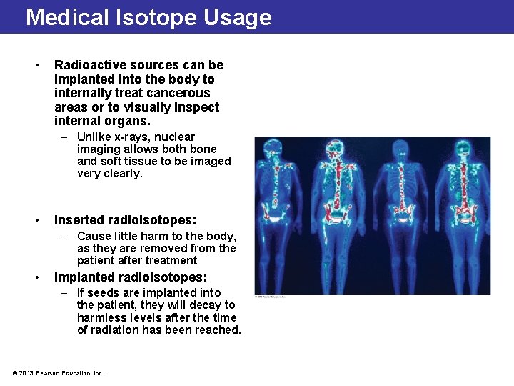 Medical Isotope Usage • Radioactive sources can be implanted into the body to internally