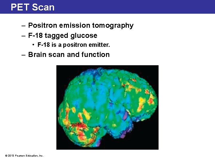 PET Scan – Positron emission tomography – F-18 tagged glucose • F-18 is a