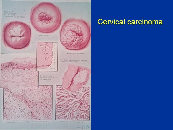 Cervical carcinoma 