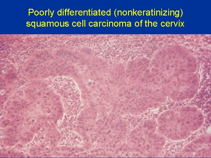 Poorly differentiated (nonkeratinizing) squamous cell carcinoma of the cervix 