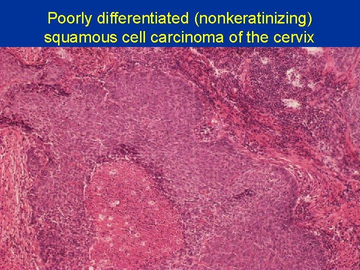Poorly differentiated (nonkeratinizing) squamous cell carcinoma of the cervix 