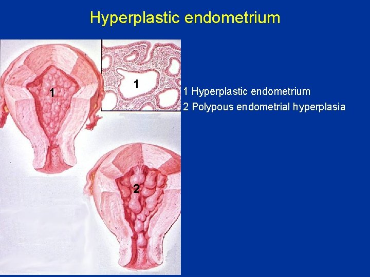 Hyperplastic endometrium 1 1 2 1 Hyperplastic endometrium 2 Polypous endometrial hyperplasia 