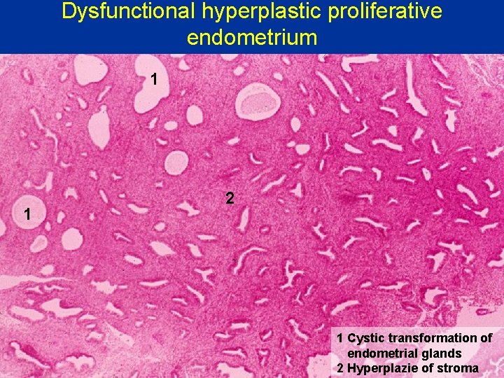 Dysfunctional hyperplastic proliferative endometrium 1 1 2 1 Cystic transformation of endometrial glands 2