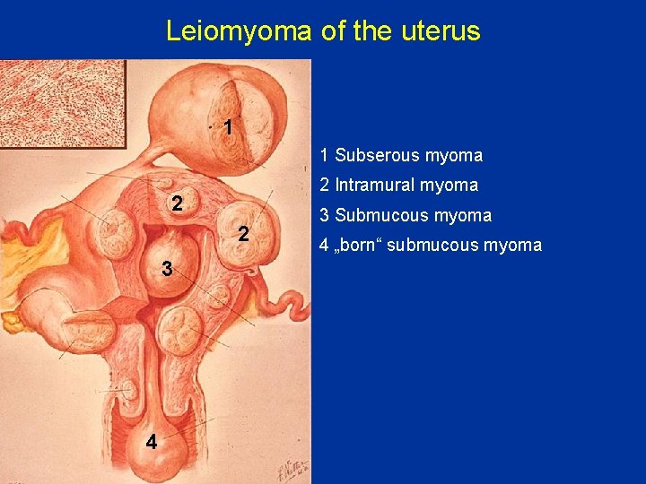 Leiomyoma of the uterus 1 1 Subserous myoma 2 Intramural myoma 2 2 3