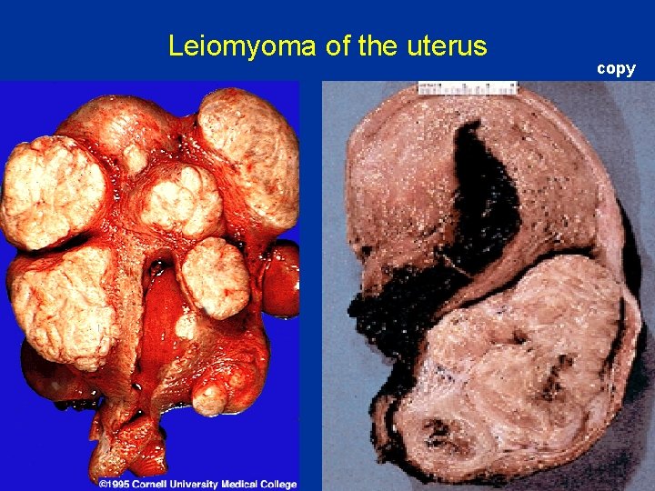 Leiomyoma of the uterus copy 