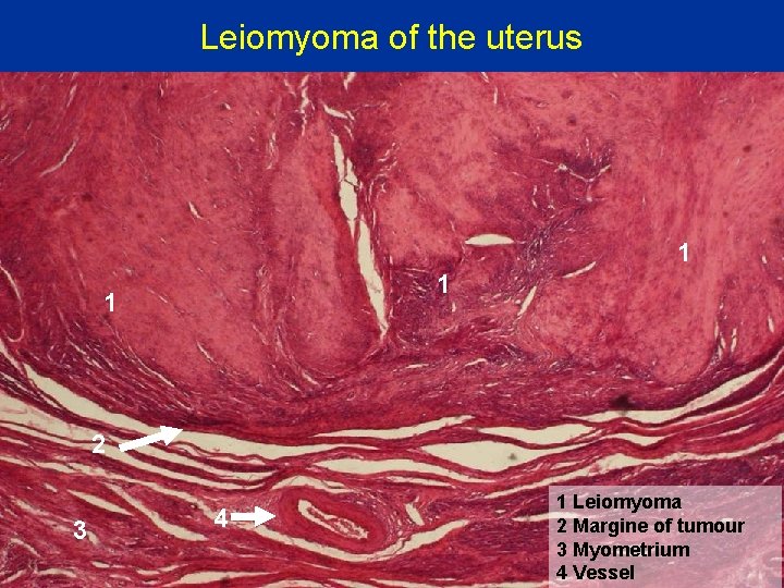 Leiomyoma of the uterus 1 1 1 2 3 4 1 Leiomyoma 2 Margine