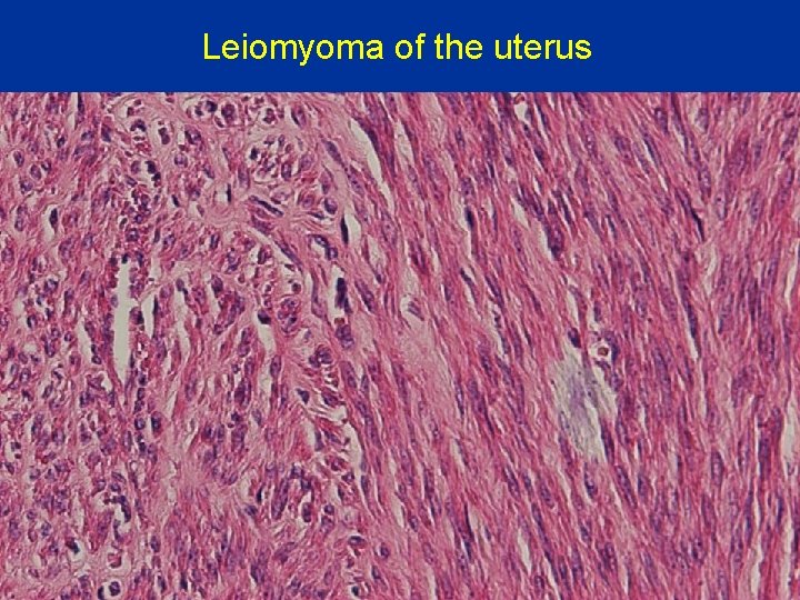 Leiomyoma of the uterus 