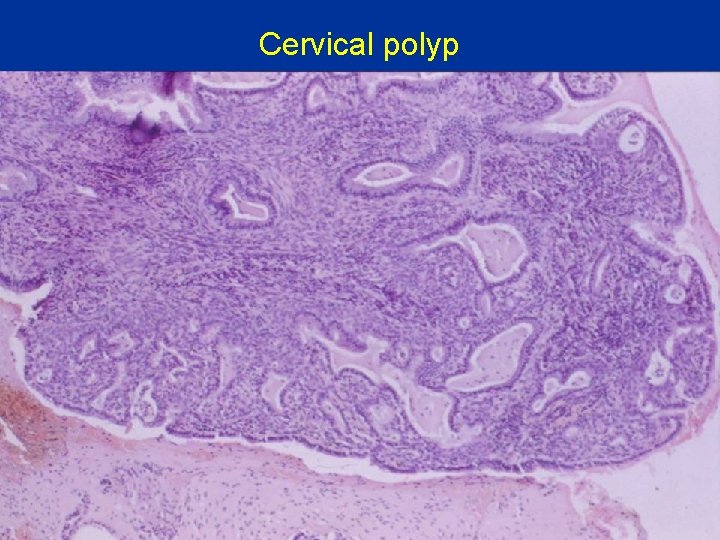 Cervical polyp 