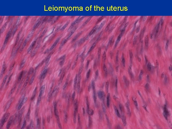 Leiomyoma of the uterus 