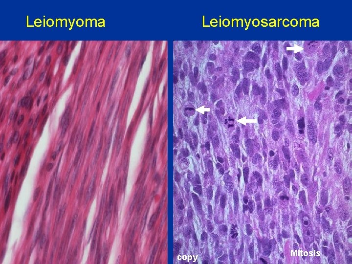 Leiomyoma 1 Leiomyosarcoma 1 1 copy Mitosis 