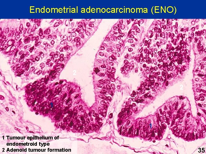 Endometrial adenocarcinoma (ENO) 2 2 1 1 1 Tumour epithelium of endometroid type 2
