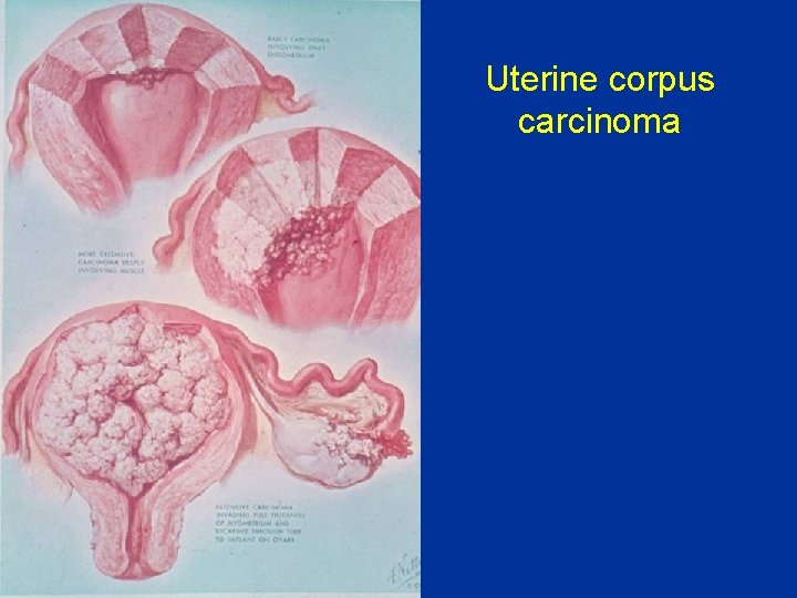Uterine corpus carcinoma 