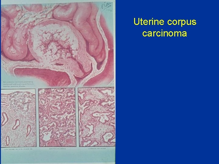 Uterine corpus carcinoma 