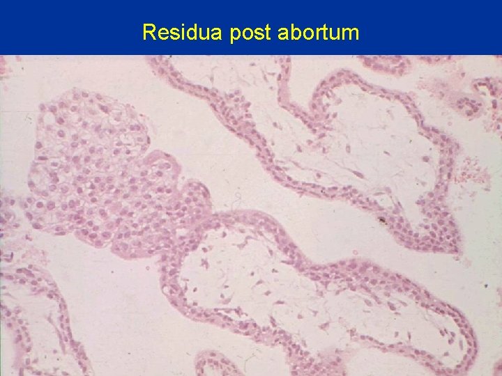 Residua post abortum 