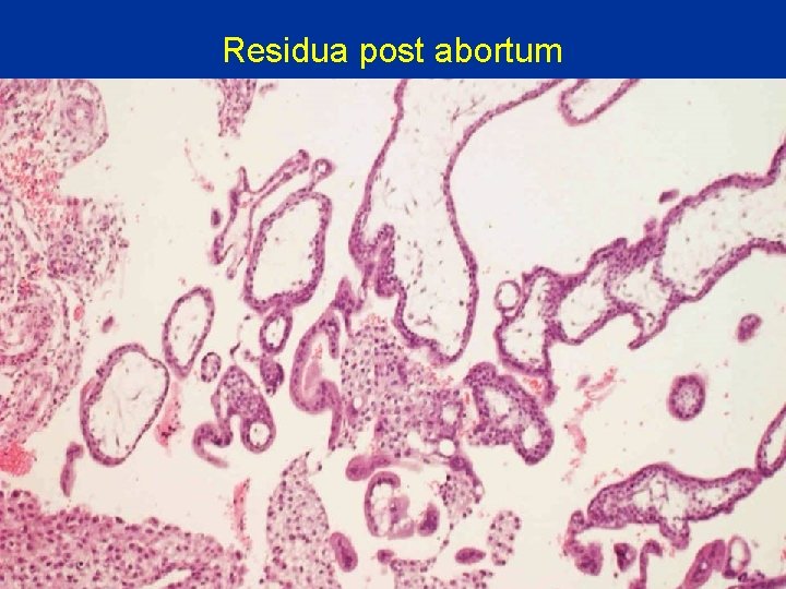 Residua post abortum 