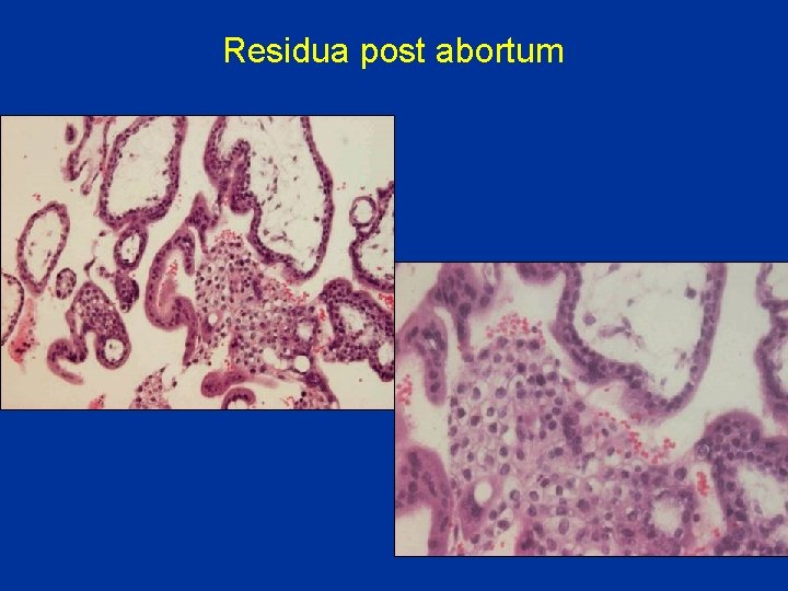 Residua post abortum 