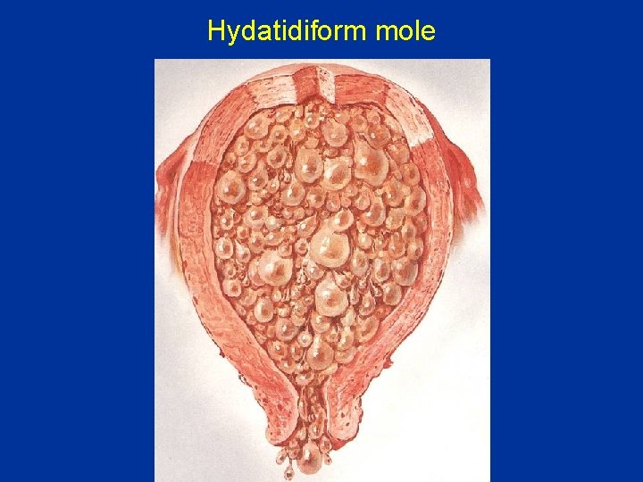 Hydatidiform mole 