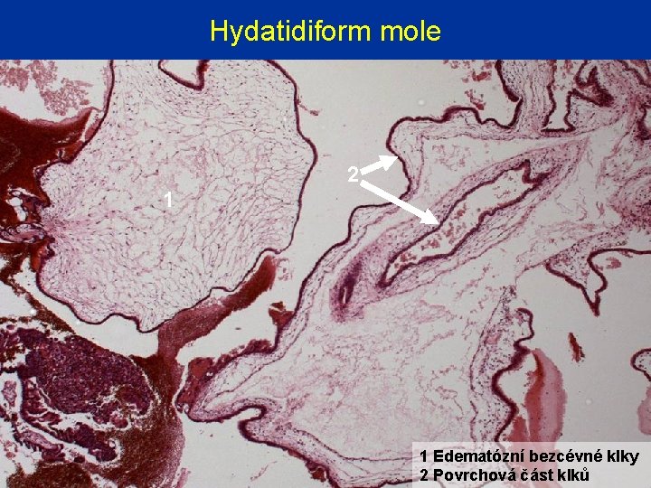 Hydatidiform mole 2 1 1 Edematózní bezcévné klky 2 Povrchová část klků 