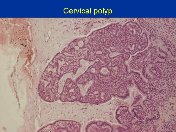 Cervical polyp 