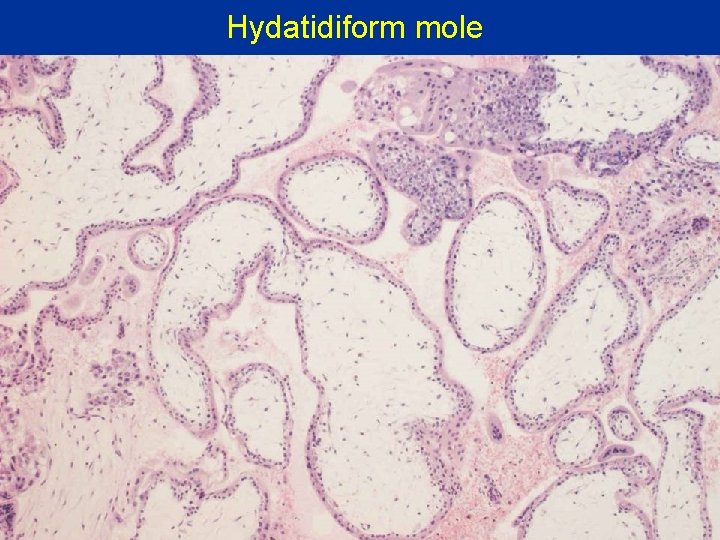 Hydatidiform mole 