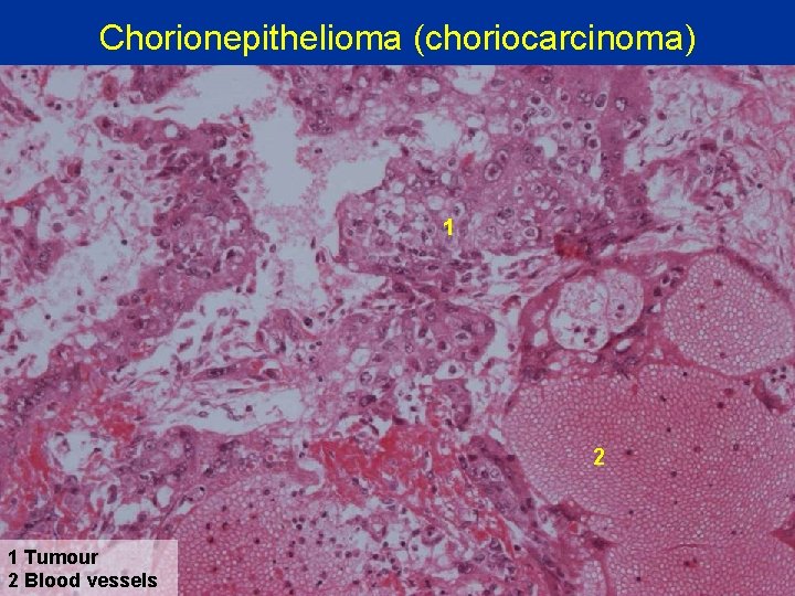 Chorionepithelioma (choriocarcinoma) 1 2 1 Tumour 2 Blood vessels 