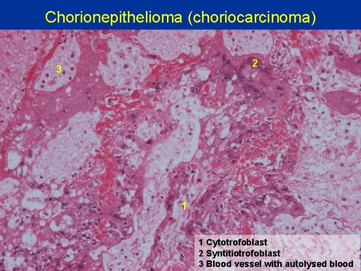 Chorionepithelioma (choriocarcinoma) 2 3 1 1 Cytotrofoblast 2 Syntitiotrofoblast 3 Blood vessel with autolysed