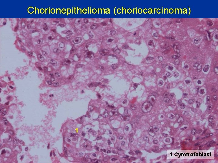 Chorionepithelioma (choriocarcinoma) 1 1 Cytotrofoblast 