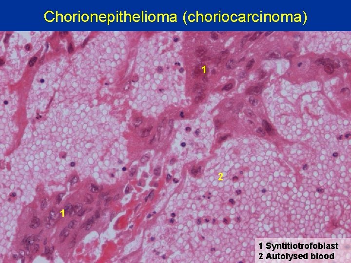 Chorionepithelioma (choriocarcinoma) 1 2 1 1 Syntitiotrofoblast 2 Autolysed blood 