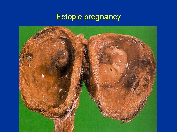 Ectopic pregnancy 