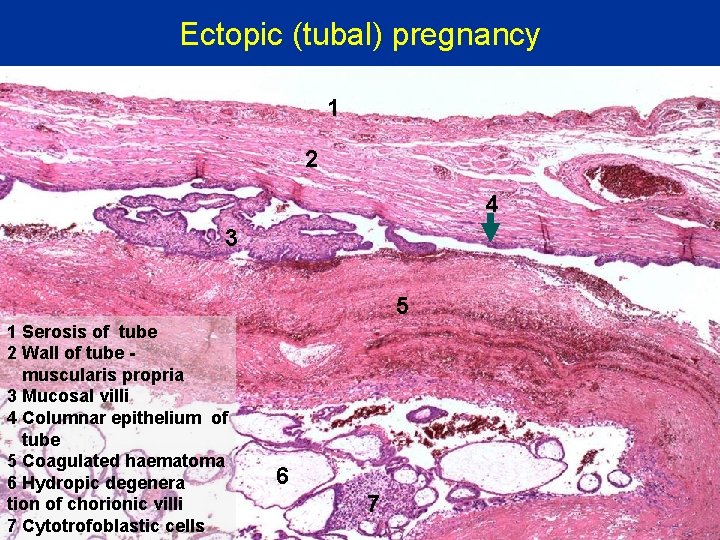 Ectopic (tubal) pregnancy 1 2 4 3 5 1 Serosis of tube 2 Wall