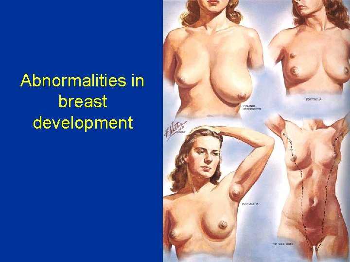 Abnormalities in breast development 