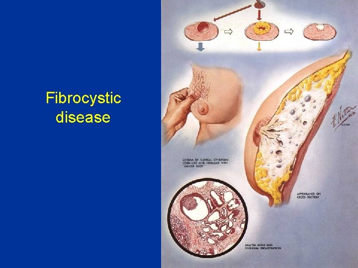 Fibrocystic disease 