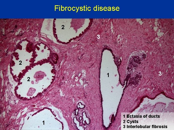 Fibrocystic disease 2 3 2 2 3 1 1 3 1 Ectasia of ducts