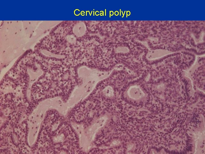 Cervical polyp 