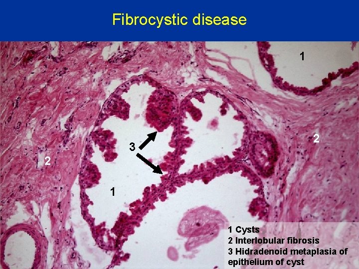 Fibrocystic disease 1 3 2 2 1 1 Cysts 2 Interlobular fibrosis 3 Hidradenoid