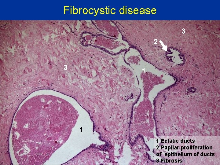 Fibrocystic disease 3 2 3 1 1 1 Ectatic ducts 2 Papilar proliferation of