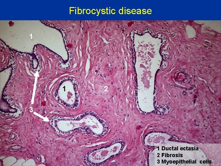 Fibrocystic disease 1 1 2 3 1 Ductal ectasia 2 Fibrosis 3 Myoepithelial cells