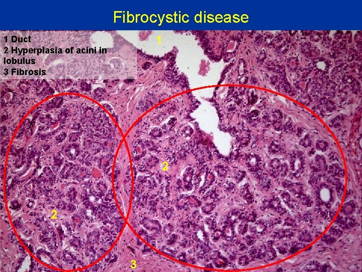 Fibrocystic disease 1 1 Duct 2 Hyperplasia of acini in lobulus 3 Fibrosis 2