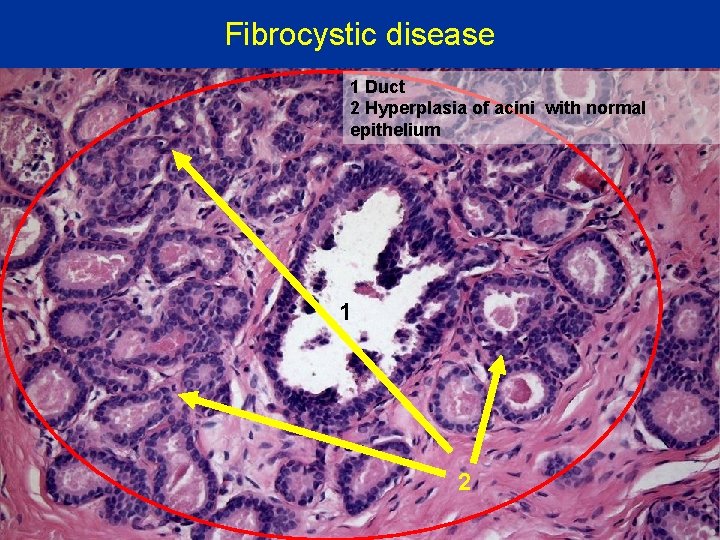 Fibrocystic disease 1 Duct 2 Hyperplasia of acini with normal epithelium 1 2 