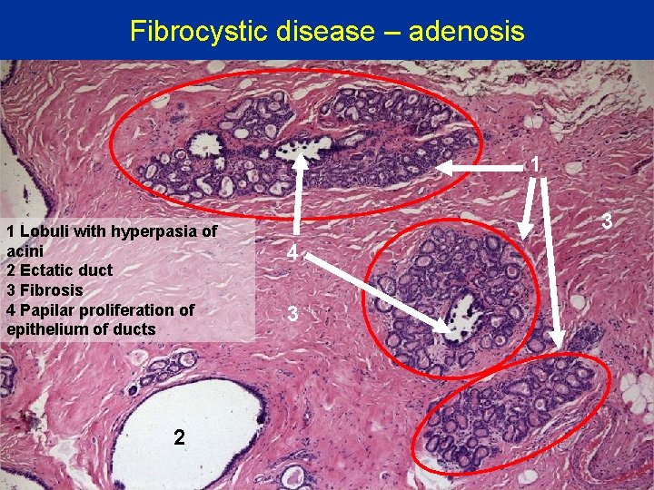 Fibrocystic disease – adenosis 1 1 Lobuli with hyperpasia of acini 2 Ectatic duct