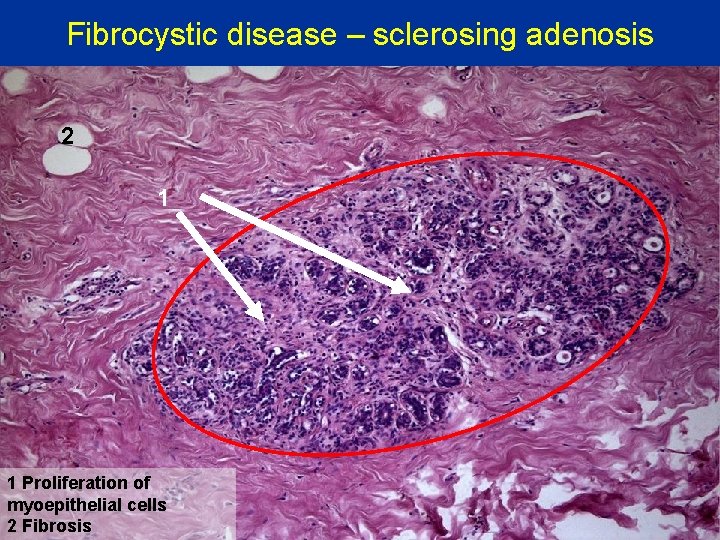 Fibrocystic disease – sclerosing adenosis 2 1 1 Proliferation of myoepithelial cells 2 Fibrosis