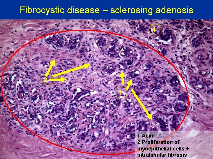 Fibrocystic disease – sclerosing adenosis 1 2 1 1 Acini 2 Proliferation of myoepithelial