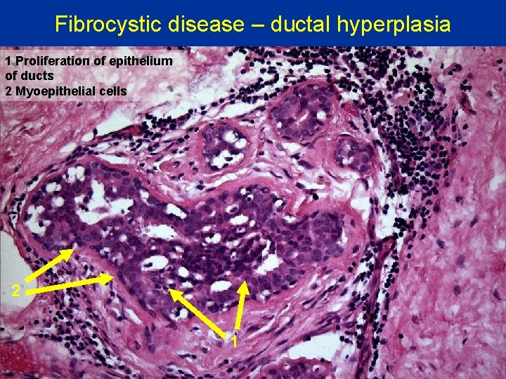 Fibrocystic disease – ductal hyperplasia 1 Proliferation of epithelium of ducts 2 Myoepithelial cells