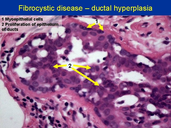Fibrocystic disease – ductal hyperplasia 1 Myoepithelial cells 2 Proliferation of epithelium of ducts