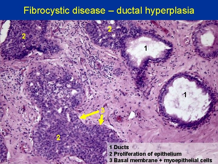 Fibrocystic disease – ductal hyperplasia 2 2 1 1 3 2 1 Ducts 2