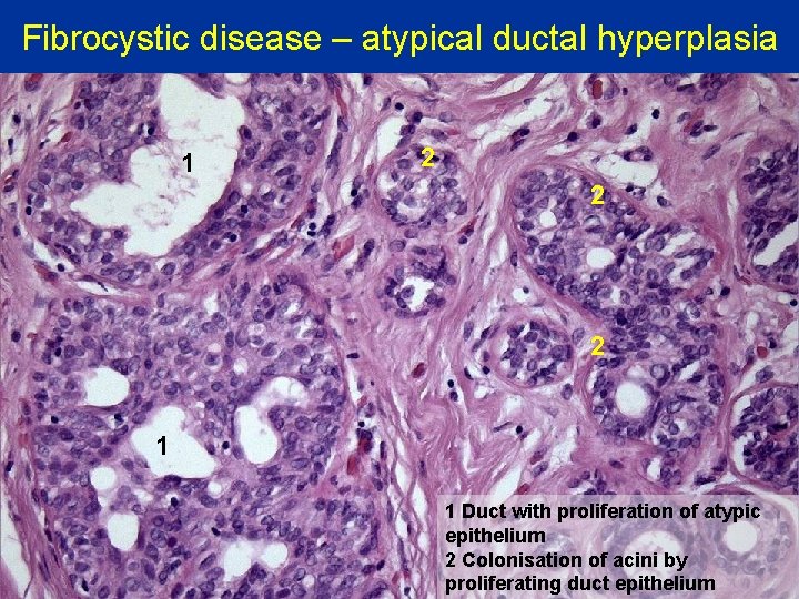 Fibrocystic disease – atypical ductal hyperplasia 1 2 2 2 1 1 Duct with