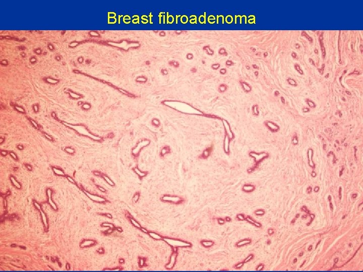 Breast fibroadenoma 