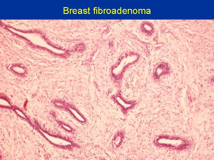 Breast fibroadenoma 