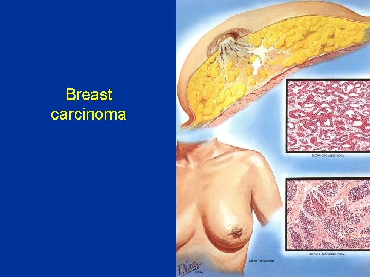 Breast carcinoma 
